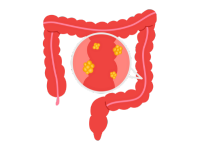 Bowel (Colorectal) Cancer 